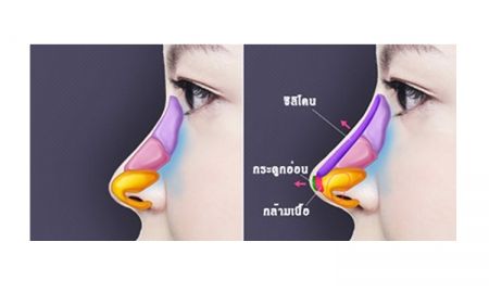 เทคนิคการเสริมจมูกแบบกระดูกอ่อนหลังหู และเนื้อเยื่อเทียม แตกต่างกันอย่างไรนะ