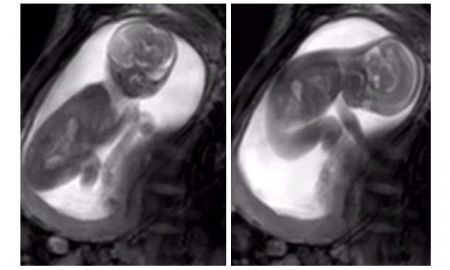 ชัดเว่อร์! ดูลูกในครรรภ์แบบใหม่ด้วยเครื่อง MRI เห็นแม้กระทั่งทารกกลืนน้ำคร่ำ